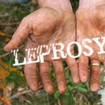 Increasing Third World Immigration Poses New Concern: Return of Leprosy